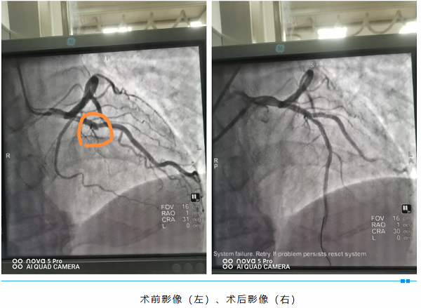 与死神赛跑，为生命接力——我院成功 抢救一名急性心肌梗死患者
